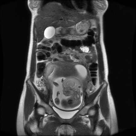 Normal MRI abdomen in pregnancy | Radiology Case | Radiopaedia.org