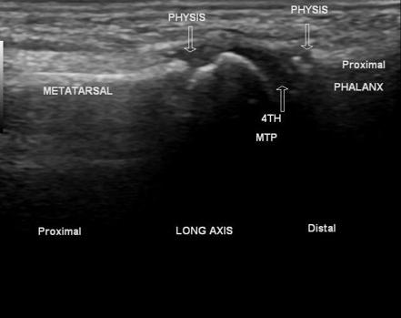 Fifth metatarsal fracture | Image | Radiopaedia.org