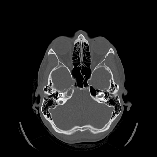 Petrous apex effusion | Image | Radiopaedia.org