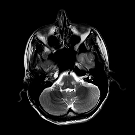 Petrous apex effusion | Image | Radiopaedia.org