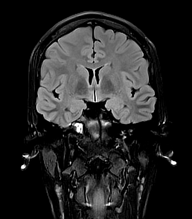 Petrous apex effusion | Radiology Case | Radiopaedia.org