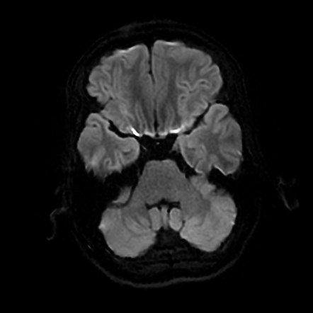 Petrous apex effusion | Image | Radiopaedia.org