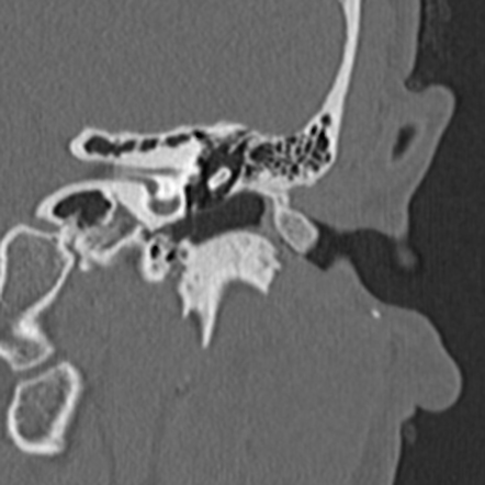 External auditory canal osteoma | Radiology Case | Radiopaedia.org