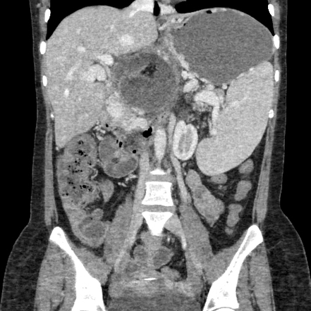 Retroperitoneal teratoma | Radiology Case | Radiopaedia.org