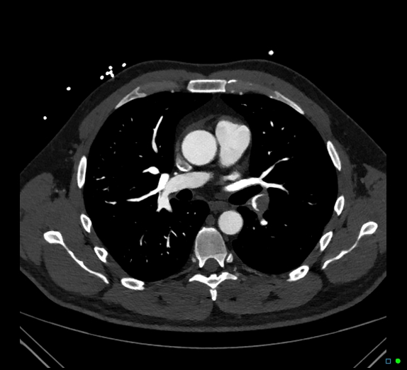 Pulmonary embolism (spectral CTPA) | Image | Radiopaedia.org