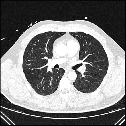 Pulmonary embolism (spectral CTPA) | Image | Radiopaedia.org