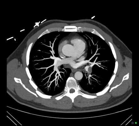 Pulmonary embolism (spectral CTPA) | Image | Radiopaedia.org