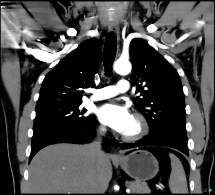 Pulmonary Embolism (spectral Ctpa) 