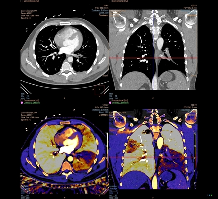 Pulmonary embolism (spectral CTPA) | Radiology Case | Radiopaedia.org