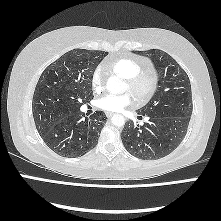 Varicella pneumonia | Image | Radiopaedia.org