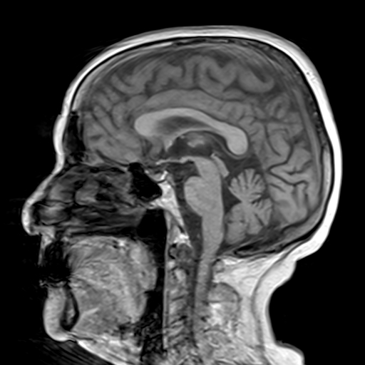 Multiple blood blister-like supraclinoid internal carotid artery ...