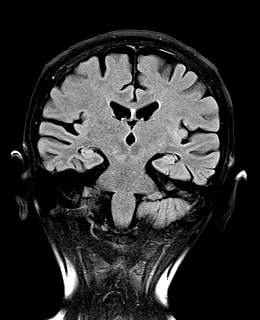 Multiple blood blister-like supraclinoid internal carotid artery ...