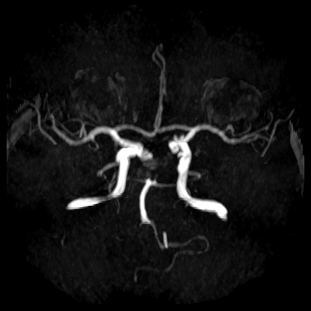 Multiple blood blister-like supraclinoid internal carotid artery ...