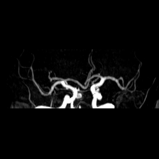 Multiple blood blister-like supraclinoid internal carotid artery ...