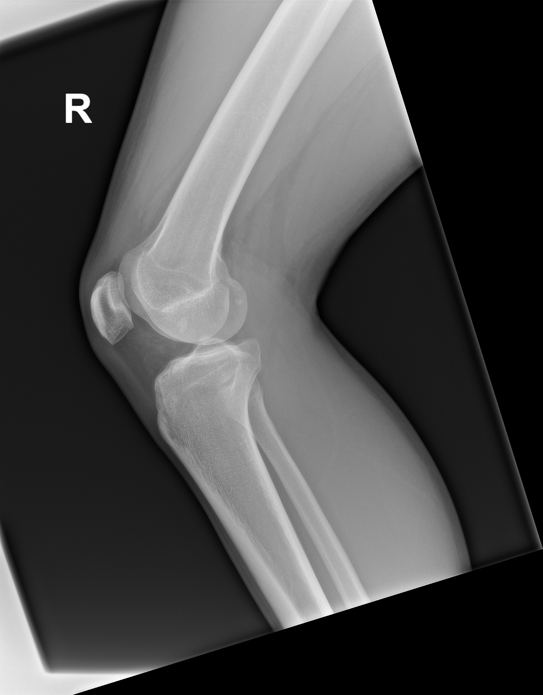 Proximal Tibiofibular Joint Horizontal Type Image Radiopaedia Org