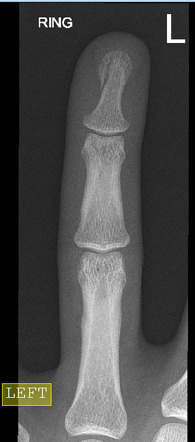 displaced fracture distal phalanx left ring finger icd 10