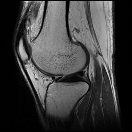 Subchondral Insufficiency Fracture Of The Knee | Image | Radiopaedia.org