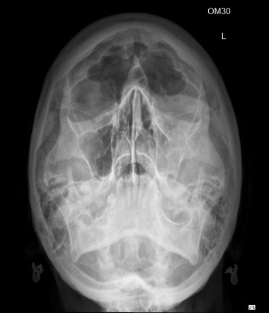 Inferior orbital floor fracture | Image | Radiopaedia.org