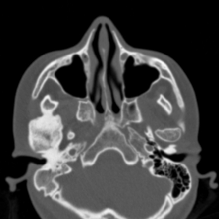 Temporomandibular Joint Ankylosis | Radiology Case | Radiopaedia.org