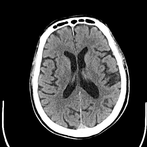 Intradiploic Epidermoid Cyst Image 7389