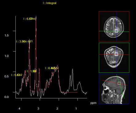 MR Spectroscopy | Radiology Reference Article | Radiopaedia.org