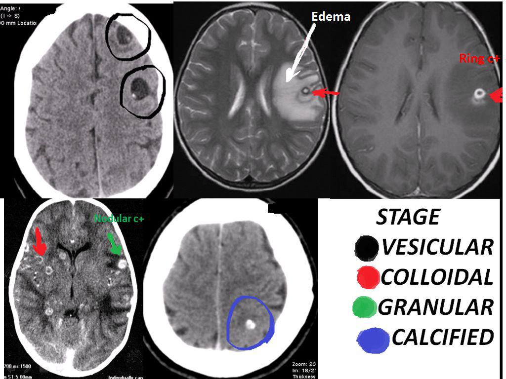 neurocysticercosis