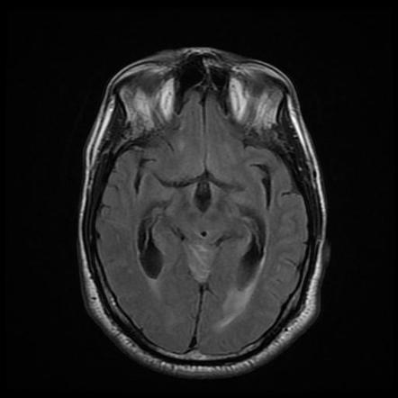 Cerebellar hemangioblastoma | Image | Radiopaedia.org