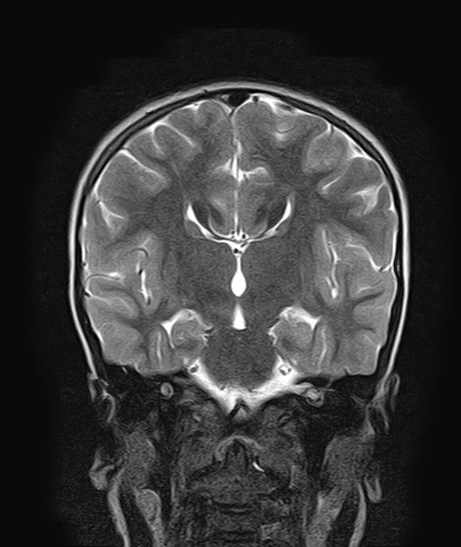 Dysgenesis Of The Corpus Callosum Image