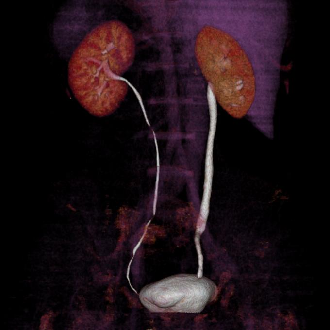 Ureterohydronephrosis due to distal ureteric stone | Image ...