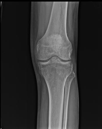 Anterior cruciate ligament bony avulsion | Radiology Case | Radiopaedia.org