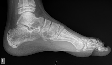 Foreign body - pencil tip | Radiology Case | Radiopaedia.org