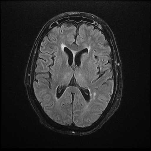 Frontal cerebritis secondary to orbital and sinus infection | Image ...