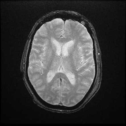 Frontal cerebritis secondary to orbital and sinus infection | Image ...