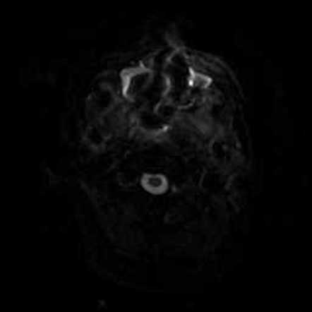 Frontal cerebritis secondary to orbital and sinus infection | Image ...