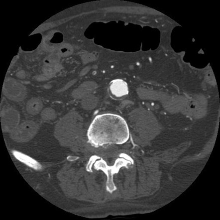 Small bowel ischemia - SMA thromboembolus | Image | Radiopaedia.org