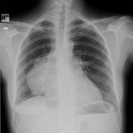 Thymic neuroendocrine carcinoma | Image | Radiopaedia.org