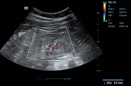 Iatrogenic renal arteriovenous fistula | Radiology Case | Radiopaedia.org