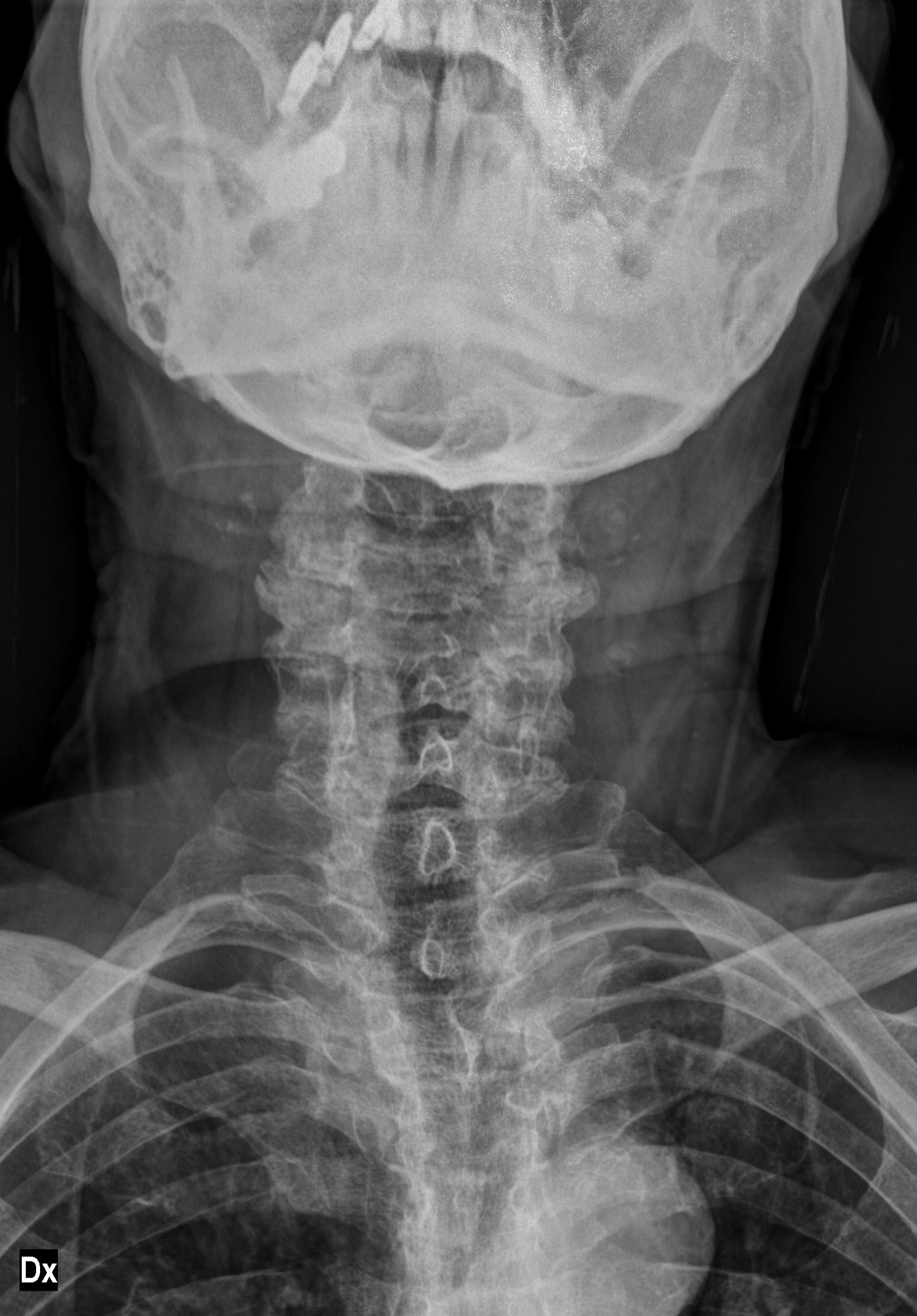 Odontoid Fracture Type Ii (anderson-d’alonzo Classification) 