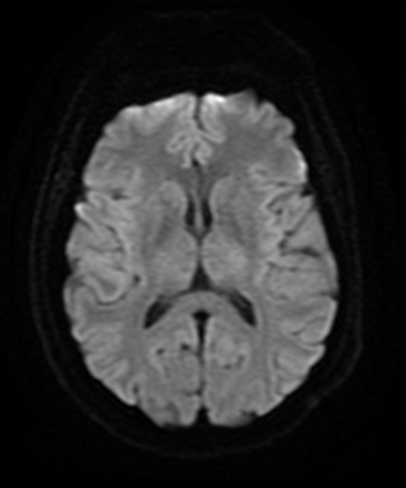 Hemorrhagic cerebral metastases from malignant melanoma | Image ...