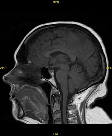 Hemorrhagic cerebral metastases from malignant melanoma | Image ...