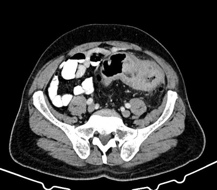 Colonic diverticulitis | Radiology Reference Article | Radiopaedia.org