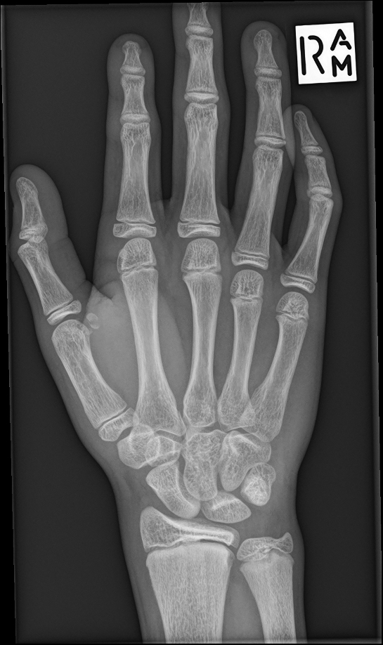 Fracture of the ulnar sesamoid of the first metacarpophalangeal joint ...