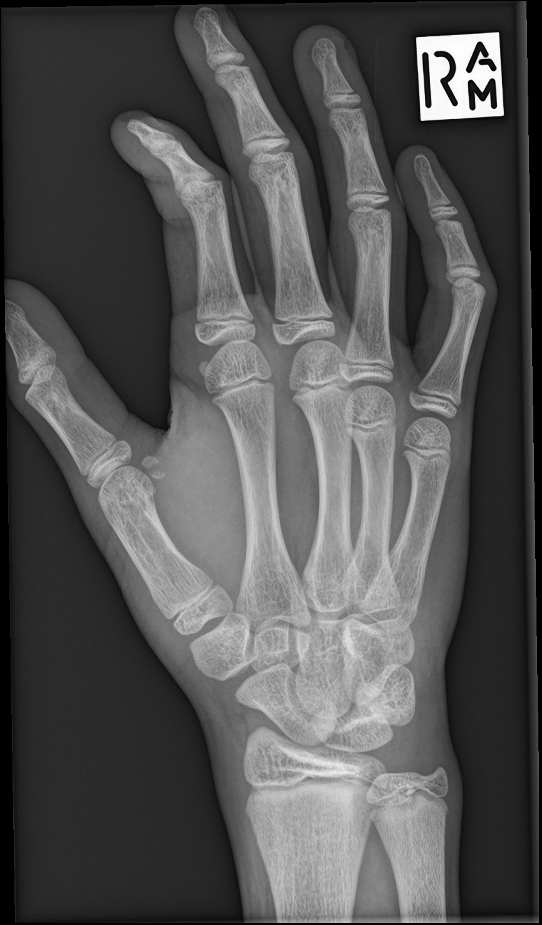 Fracture of the ulnar sesamoid of the first metacarpophalangeal joint ...