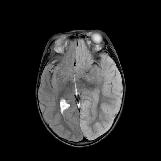 Extensive cerebral infarct in a child with Tetralogy of Fallot | Image ...