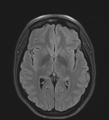 Occipital sinus | Image | Radiopaedia.org