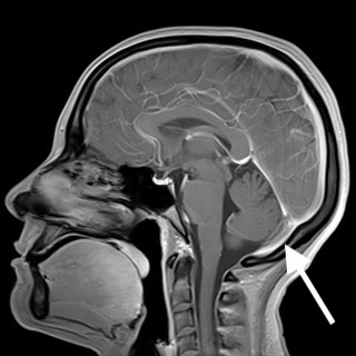 Occipital sinus | Image | Radiopaedia.org