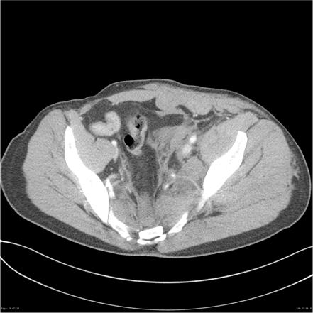 Traumatic pelvic and sacral fractures | Image | Radiopaedia.org