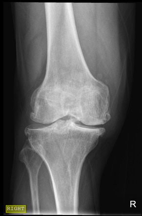 Synovial chondromatosis | Radiology Case | Radiopaedia.org