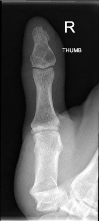 File:Enchondrom Tibia 83jm - Roe ap und seitlich - 001.jpg - Wikimedia  Commons