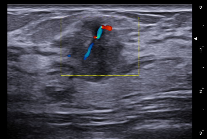 Mucinous Breast Carcinoma - Young Patient | Image | Radiopaedia.org